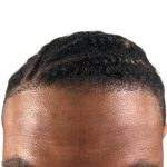 Hair Transplants Before & After Patient #1148