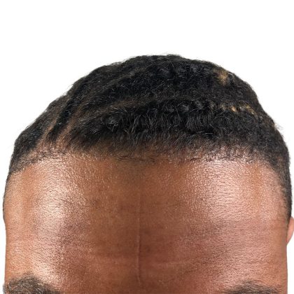 Hair Transplants Before & After Patient #1148