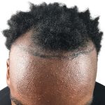 Hair Transplants Before & After Patient #1231