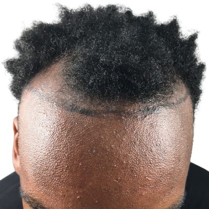 Hair Transplants Before & After Patient #1231