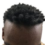 Hair Transplants Before & After Patient #1231