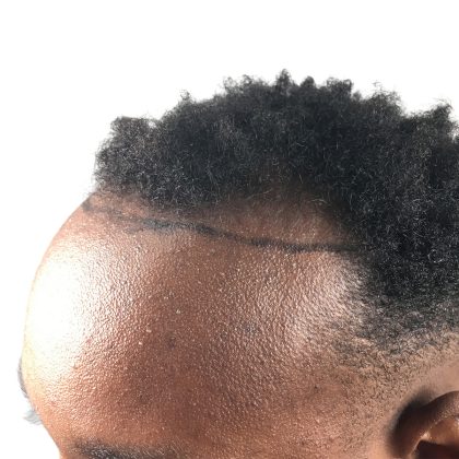 Hair Transplants Before & After Patient #1231