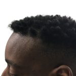 Hair Transplants Before & After Patient #1231