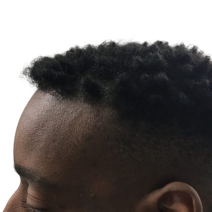 Hair Transplants Before & After Patient #1231