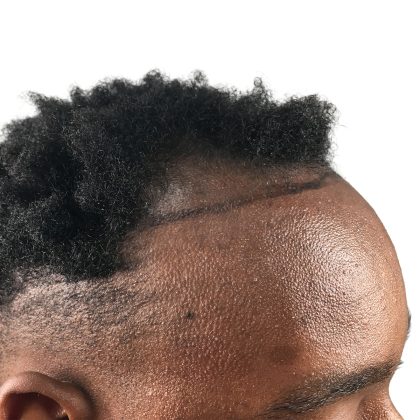 Hair Transplants Before & After Patient #1231