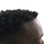Hair Transplants Before & After Patient #1231