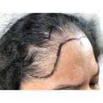Hair Transplants Before & After Patient #1232