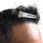 Hair Transplants Before & After Patient #1233