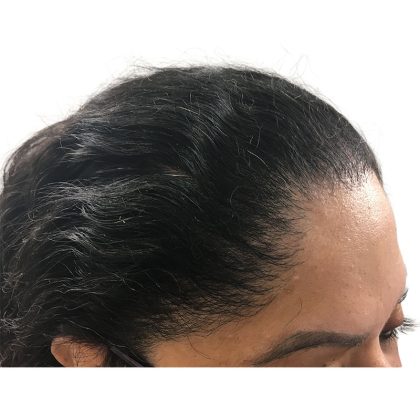 Hair Transplants Before & After Patient #1232