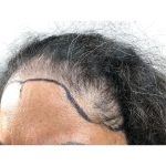 Hair Transplants Before & After Patient #1232