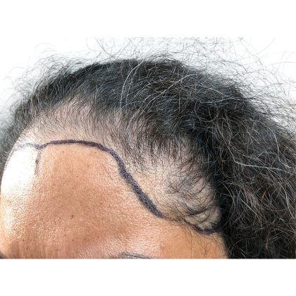 Hair Transplants Before & After Patient #1232