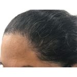 Hair Transplants Before & After Patient #1232