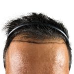 Hair Transplants Before & After Patient #1233