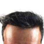 Hair Transplants Before & After Patient #1233