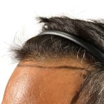 Hair Transplants Before & After Patient #1233
