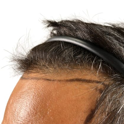 Hair Transplants Before & After Patient #1233