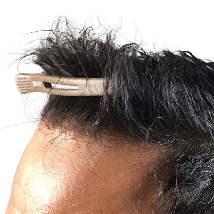 Hair Transplants Before & After Patient #1233