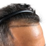 Hair Transplants Before & After Patient #1233