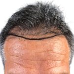 Hair Transplants Before & After Patient #1234