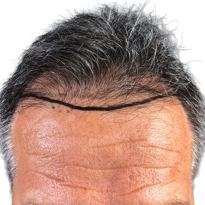 Hair Transplants Before & After Patient #1234
