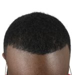 Hair Transplants Before & After Patient #1235