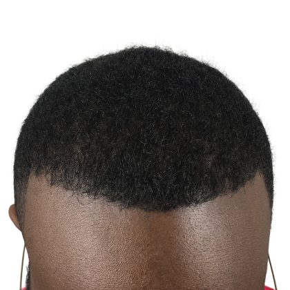 Hair Transplants Before & After Patient #1235