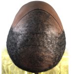 Hair Transplants Before & After Patient #1235