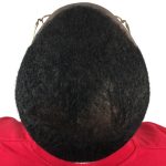Hair Transplants Before & After Patient #1235