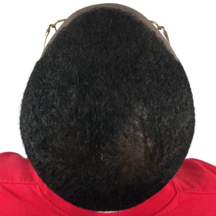 Hair Transplants Before & After Patient #1235
