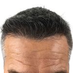Hair Transplants Before & After Patient #1234