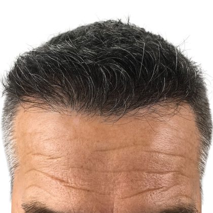 Hair Transplants Before & After Patient #1234