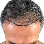 Hair Transplants Before & After Patient #1234