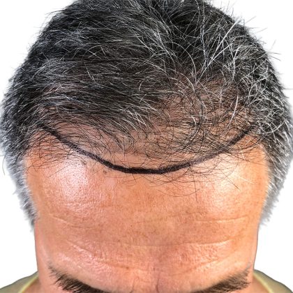 Hair Transplants Before & After Patient #1234