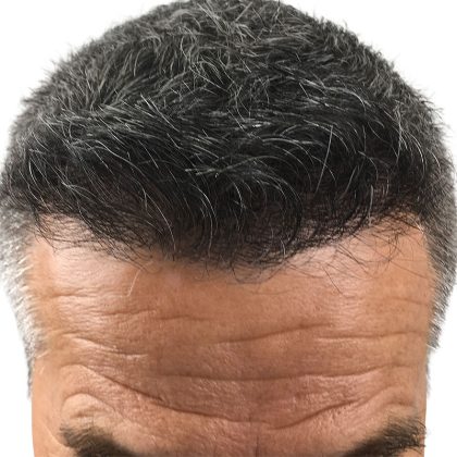 Hair Transplants Before & After Patient #1234