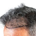 Hair Transplants Before & After Patient #1234