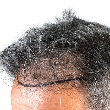 Hair Transplants Before & After Patient #1234