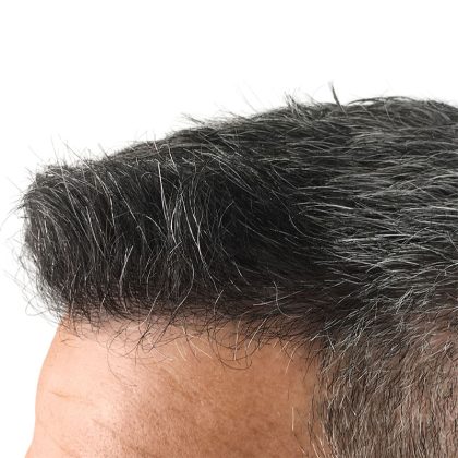 Hair Transplants Before & After Patient #1234