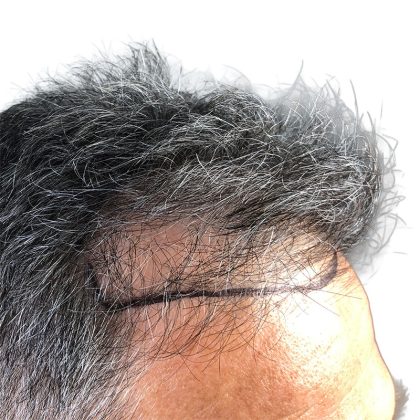 Hair Transplants Before & After Patient #1234