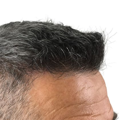 Hair Transplants Before & After Patient #1234