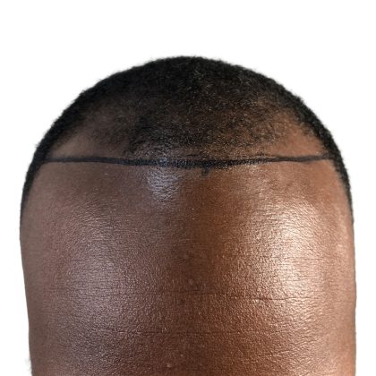 Hair Transplants Before & After Patient #1235