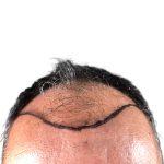 Hair Transplants Before & After Patient #1264