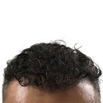 Hair Transplants Before & After Patient #1264