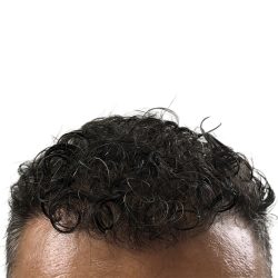 Hair Transplants Before & After Patient #1264