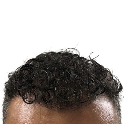 Hair Transplants Before & After Patient #1264