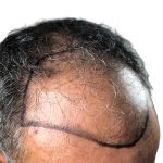 Hair Transplants Before & After Patient #1264