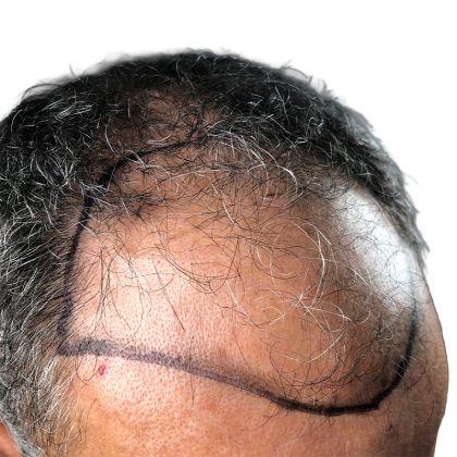 Hair Transplants Before & After Patient #1264