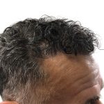 Hair Transplants Before & After Patient #1264