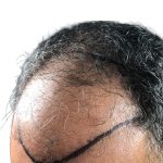 Hair Transplants Before & After Patient #1264