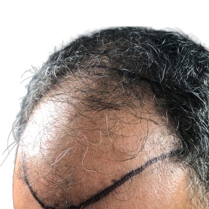 Hair Transplants Before & After Patient #1264
