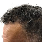 Hair Transplants Before & After Patient #1264